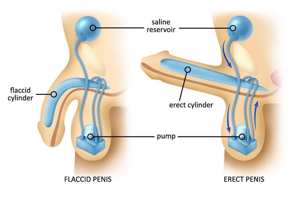 What is a Vacuum Erection Device for ED