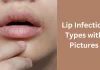 Lip Infection Types with Pictures