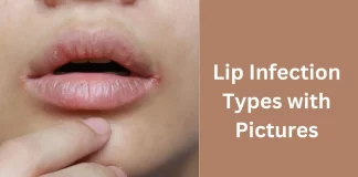 Lip Infection Types with Pictures