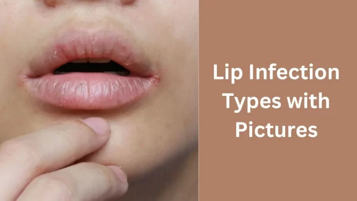 Lip Infection Types with Pictures