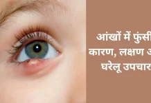 Pimple in eyes: Causes, symptoms, and home remedies